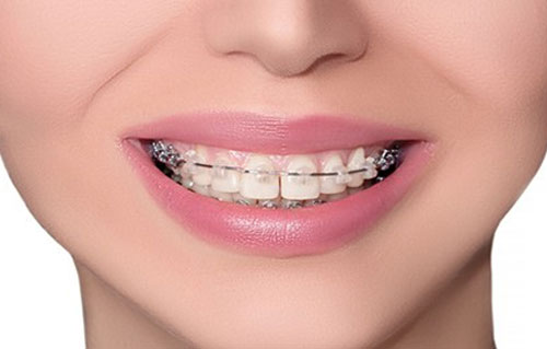 Ortodonzia - Braces. Ortodonzia per adolescenti e ragazzi e adulti