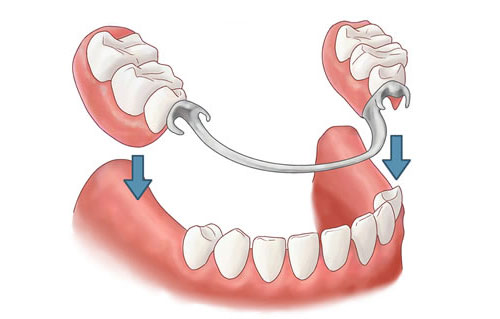 Protesi.Protesi di fusione modulare con giunti.Protesi morbide Valplast. Dentiere Thermosense