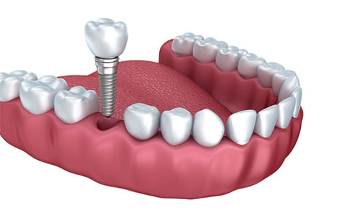 Dental Implants