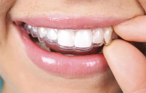 Invisalign and clear correct