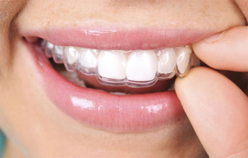 Invisalign e clear correct