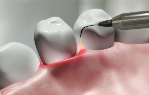 Contemporary, intelligent, athletic dental laser treatment. Laser brightening