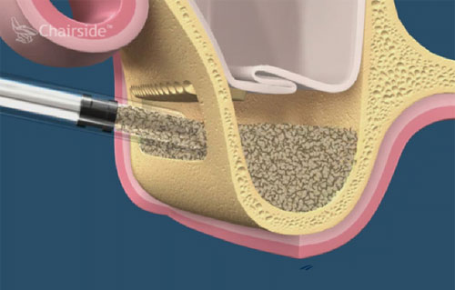 Open and closed sinus lift. Bone grafting