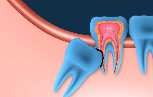 Oral surgery. Impacted wisdom tooth