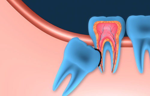 Орална хирургия. Ретенирани мъдреци